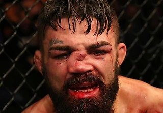 Самый жесткий перелом в истории UFC